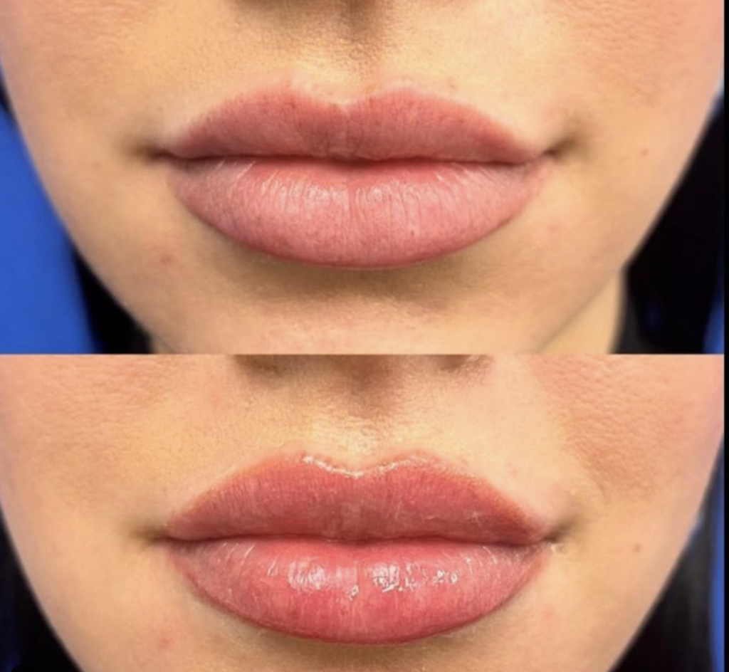 El láser Lip Flip, una nueva forma de aumentar los labios sin agujas