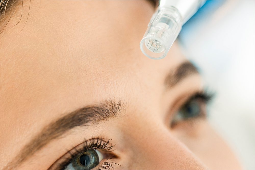 microneedling