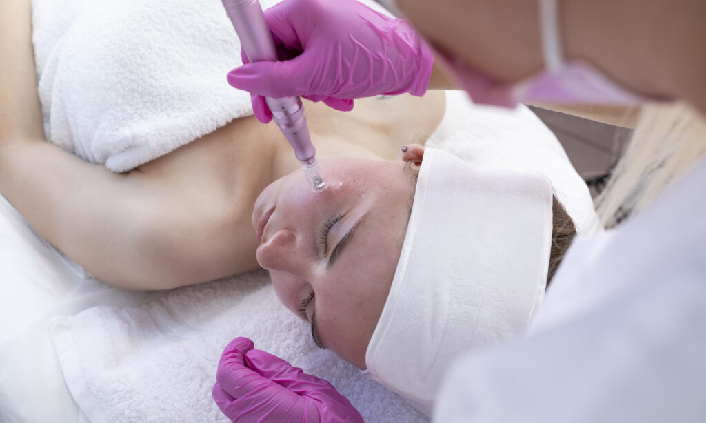 Los médicos responden a las 10 preguntas más frecuentes sobre el microneedling featured image