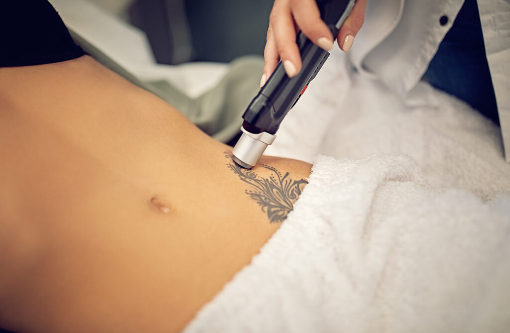 Borrón y cuenta nueva: Todo sobre la eliminación de tatuajes con tecnología láser featured image