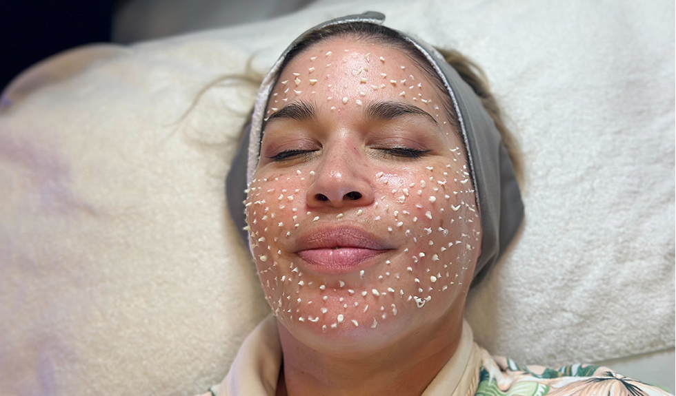 Probé el microneedling líquido, el tratamiento de moda para una piel más suave featured image