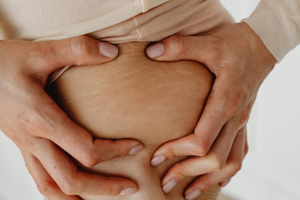 estrías, stretch marks, cómo aclarar las estrías