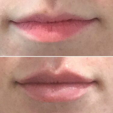 Lip flip antes y después