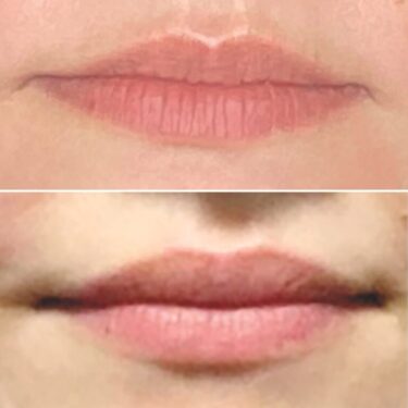 Lip flip antes y después