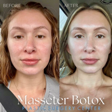 Botox en el masetero