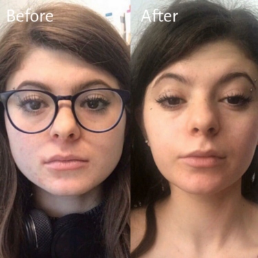 Botox en el masetero