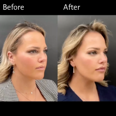 Botox en el masetero