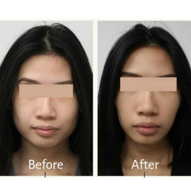 Botox en el masetero