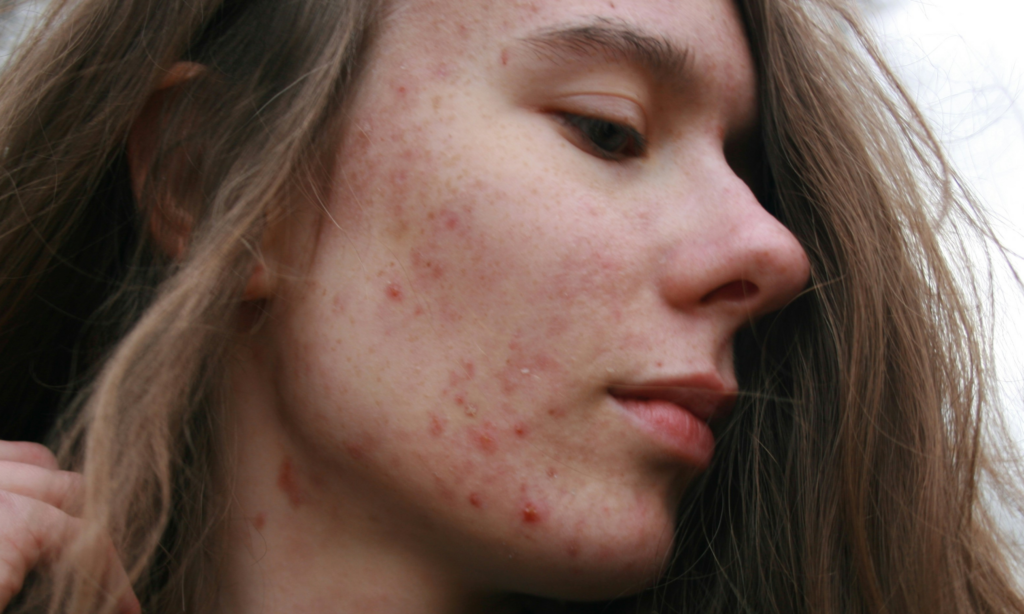 Los errores que disparan tu acné en verano y cómo evitarlos featured image