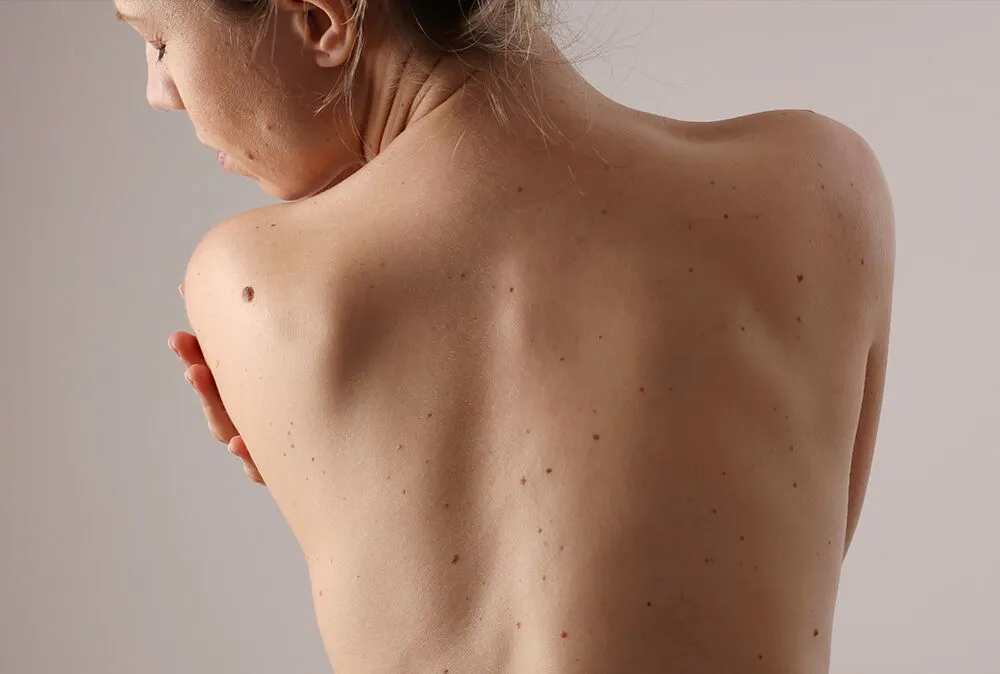 Cómo diferenciar entre un cáncer de piel y un granito featured image
