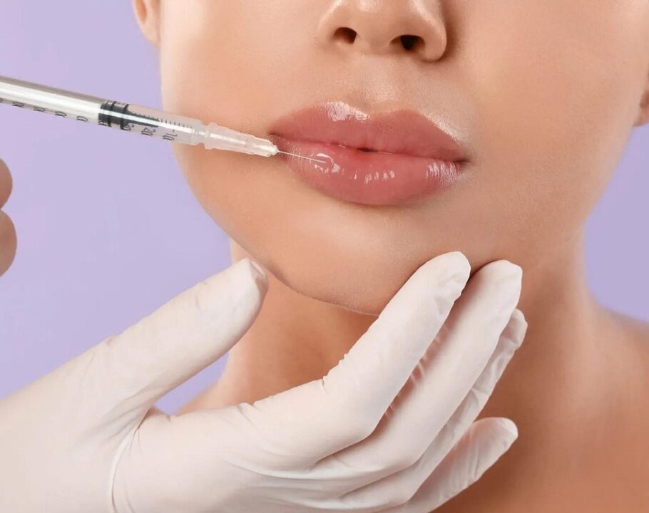 lips, lip filler, filler, botox, facial treatment, injection, beauty, botox, botox, botox, botox, botox