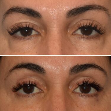 blefaroplastia