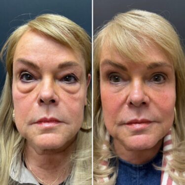 blefaroplastia