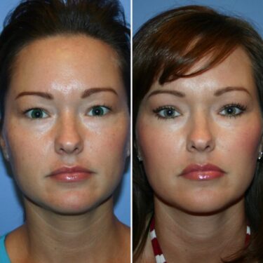 blefaroplastia