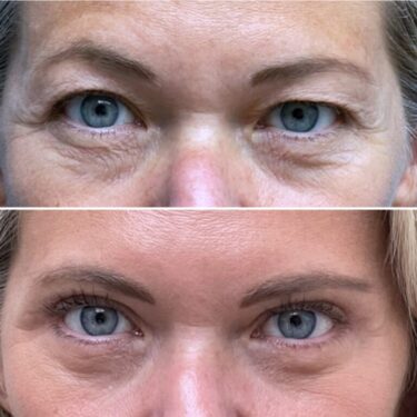 blefaroplastia