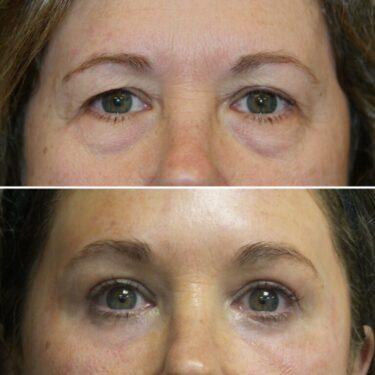 blefaroplastia
