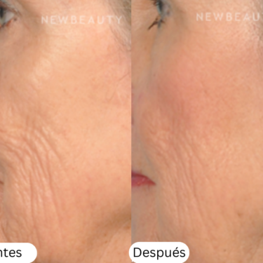 microneedling antes y despu&eacute;s