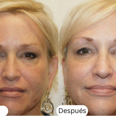 microneedling antes y despu&eacute;s