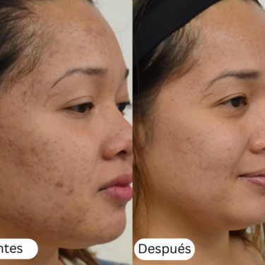 Microneedling antes y despu&eacute;s