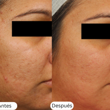 microneedling antes y despu&eacute;s