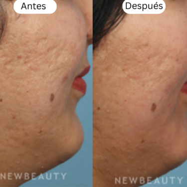 microneedling antes y despu&eacute;s