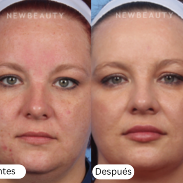 microneedling antes y despu&eacute;s