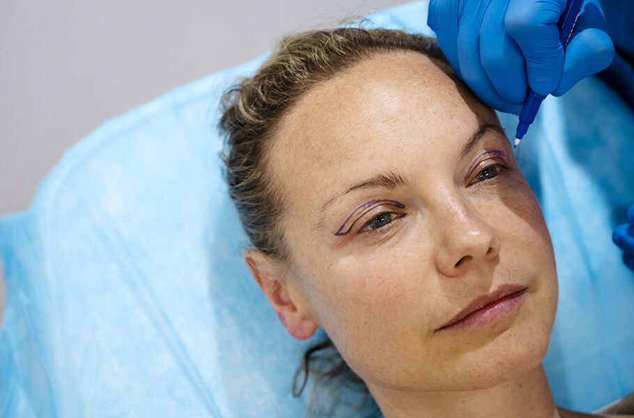 blefaroplastia