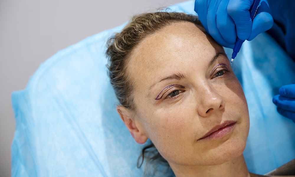 Esto es lo que logra una blefaroplastia: Antes y después featured image