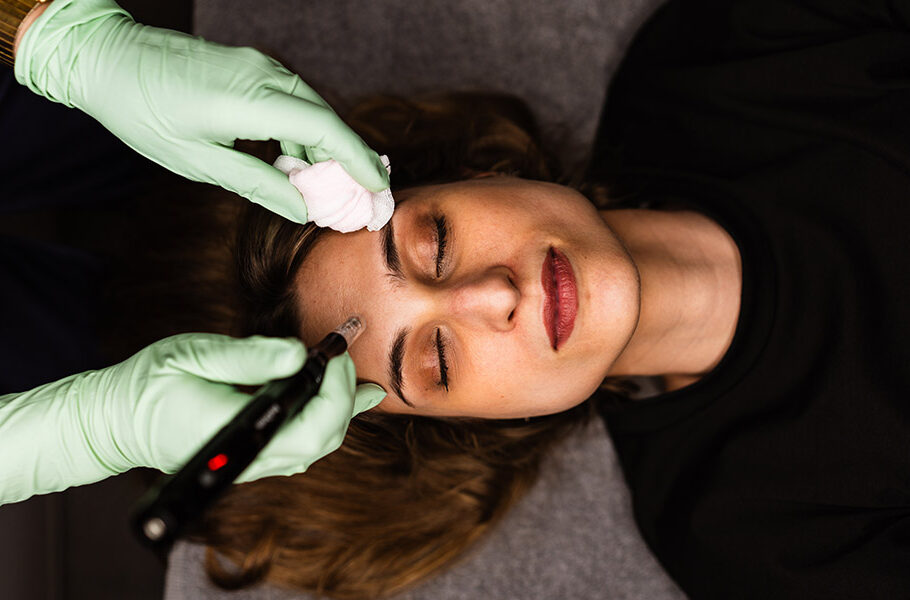 microneedling antes y después