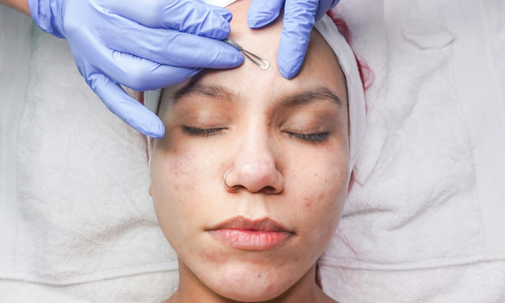 ¿Bótox para mejorar el acné y la textura de la piel? Todo lo que debes saber antes de aplicártelo featured image