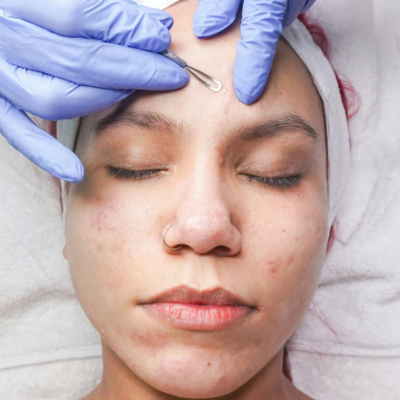 mujer con acné, botox