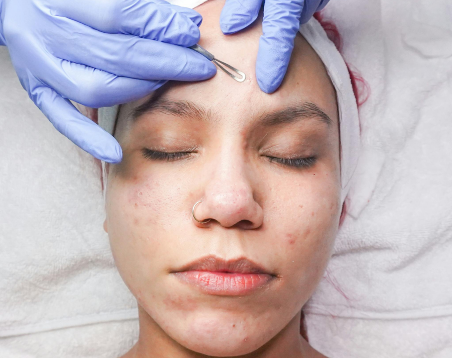 mujer con acné, botox