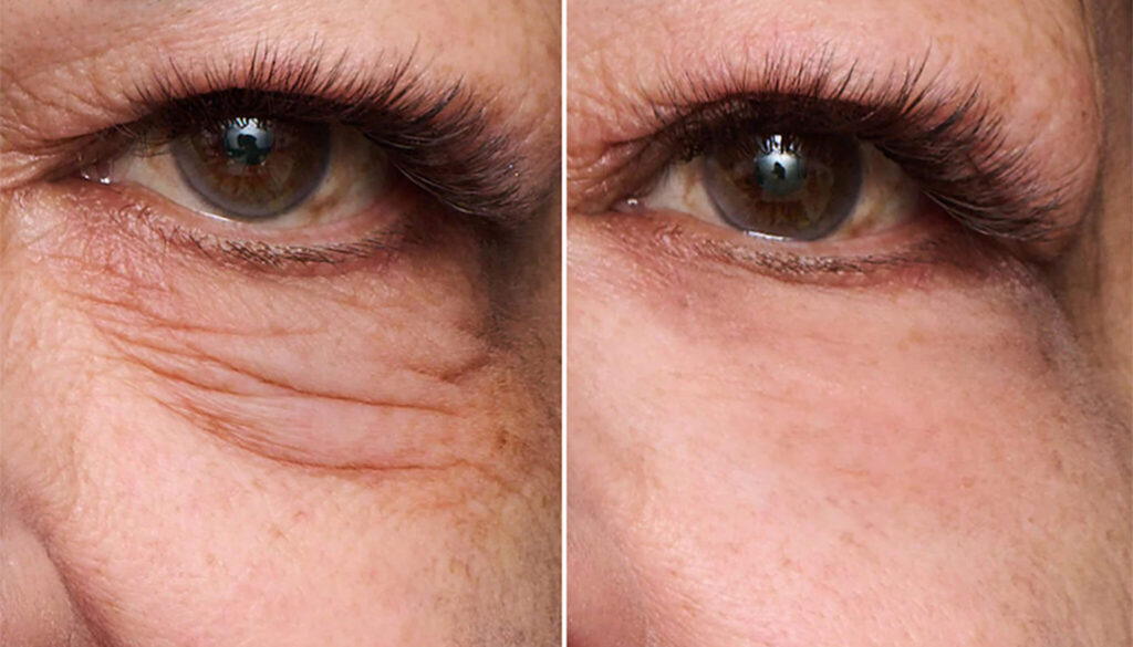 Los productos para el contorno de ojos con los antes y después más sorprendentes featured image
