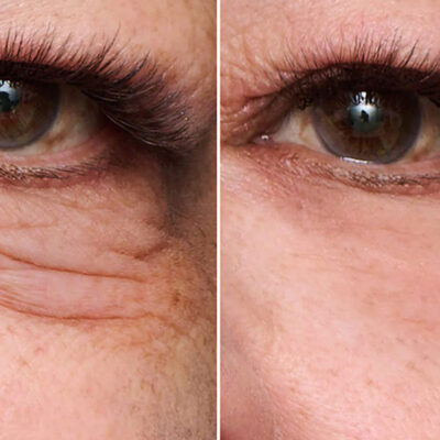 contorno de ojos antes y después