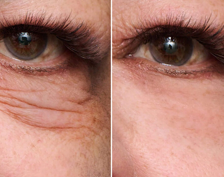contorno de ojos antes y después